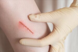 When does a wound need stitches?, Health Channel