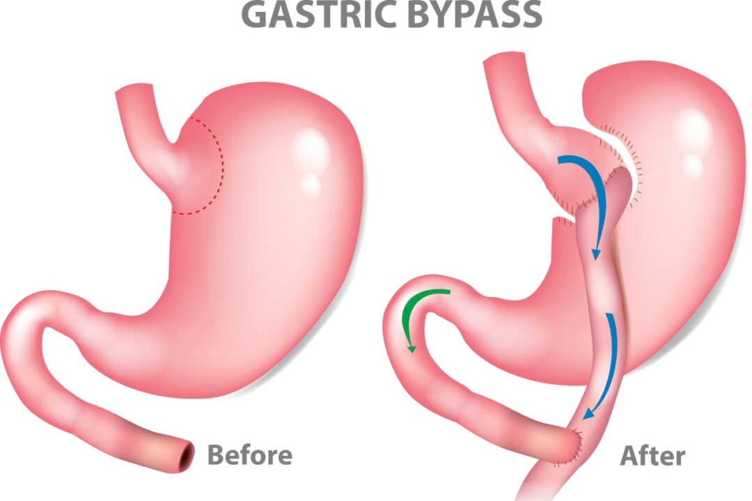 When is Gastric Bypass surgery a good option?, Health Channel