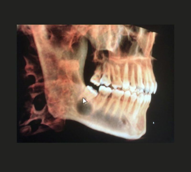 Impacted Wisdom Teeth: X-Ray View