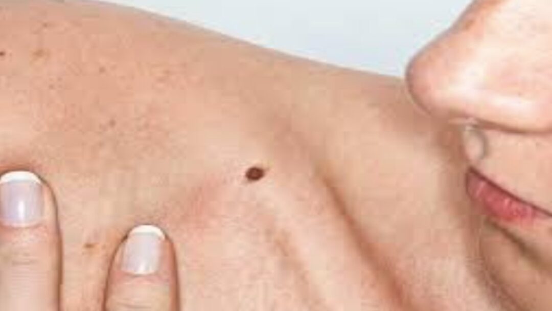 The 3 Types of Skin Cancer | Health Channel, Health Channel