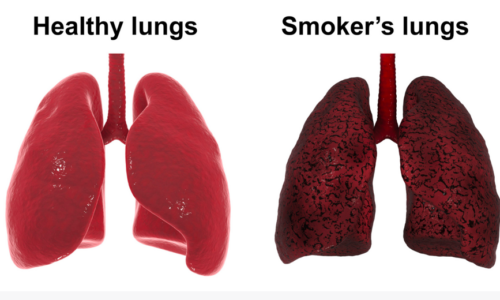 The Damage of Smoking: Examining Smoker’s Lungs