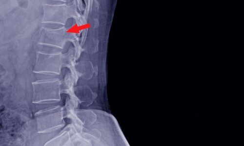 Diagnosing of Spinal Fractures