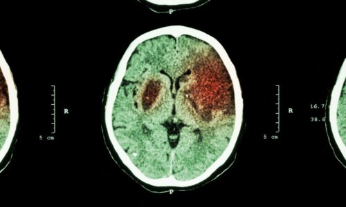 Understanding Ischemic and Hemorrhagic Strokes: Causes and Effects