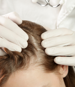 Scalp Conditions: Eczema, Psoriasis, & Alopecia